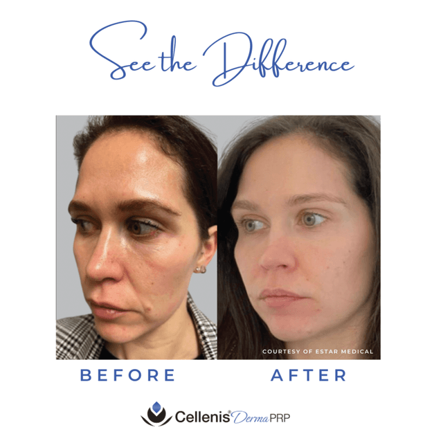 2 PRP Sessions: Large